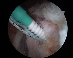 Endoscopic Abductor Tendon Repair